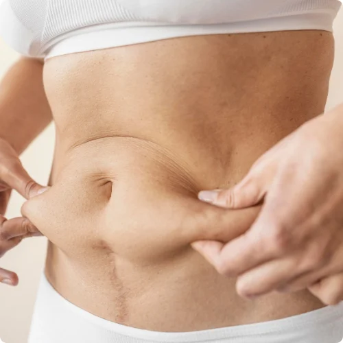 Mesoterapia Corporal