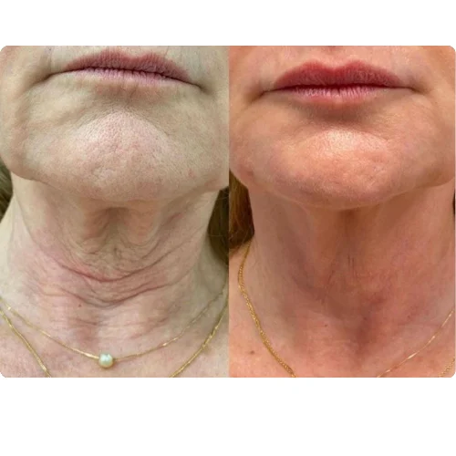 Preenchimento Labial